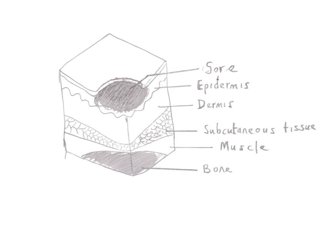 Image of stage 2 pressure sore 