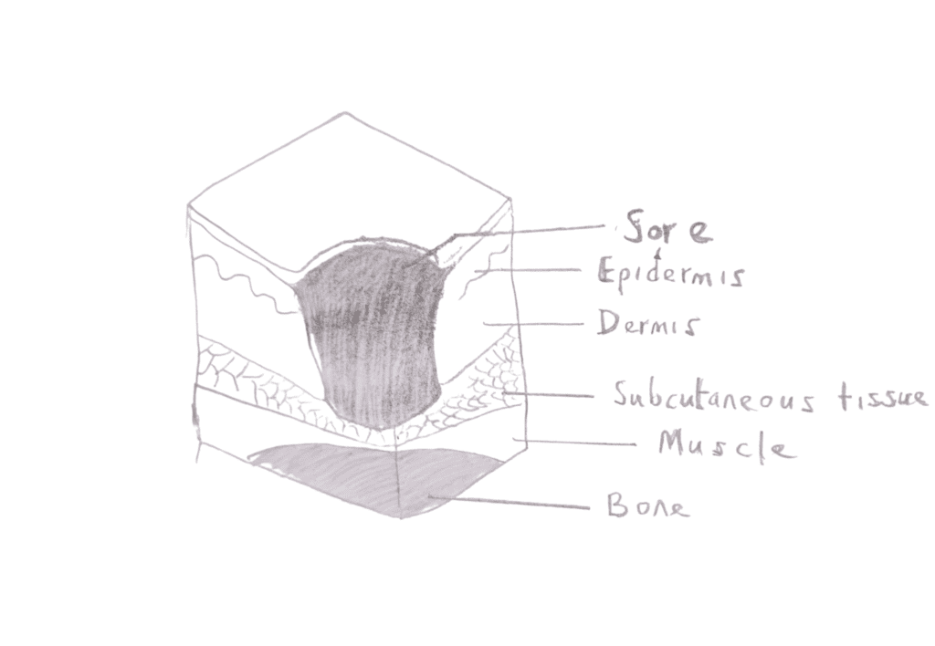 Image of stage 3 pressure sore