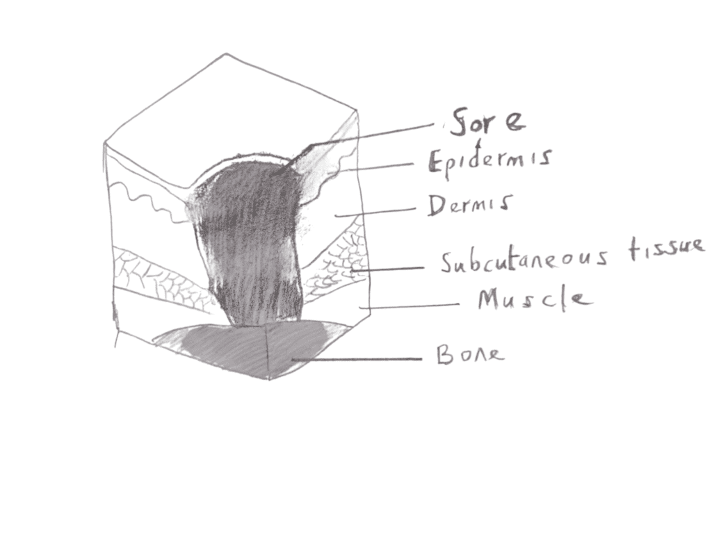 Image of stage 4 pressure sore 